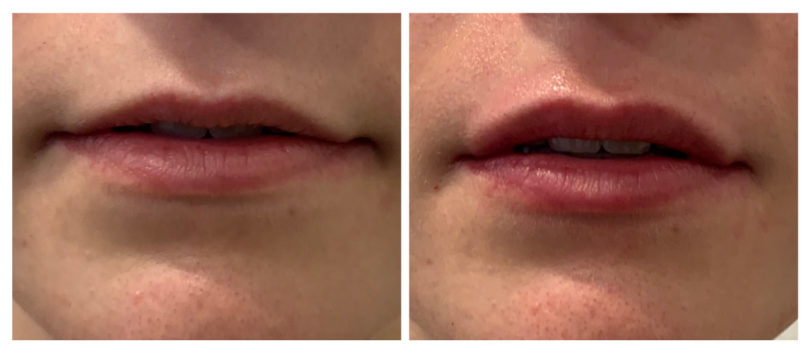aumento-labial1-1-810x355 (1)
