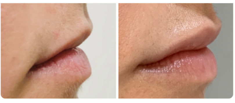 aumento-labial2-810x355