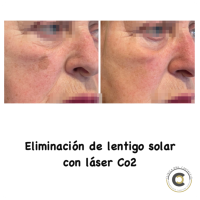 lentigo-solar-400x400