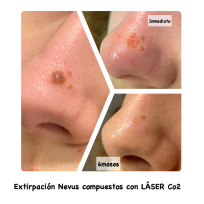 nevus-400x400