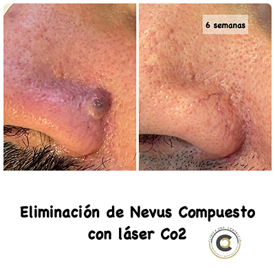 nevus-laser