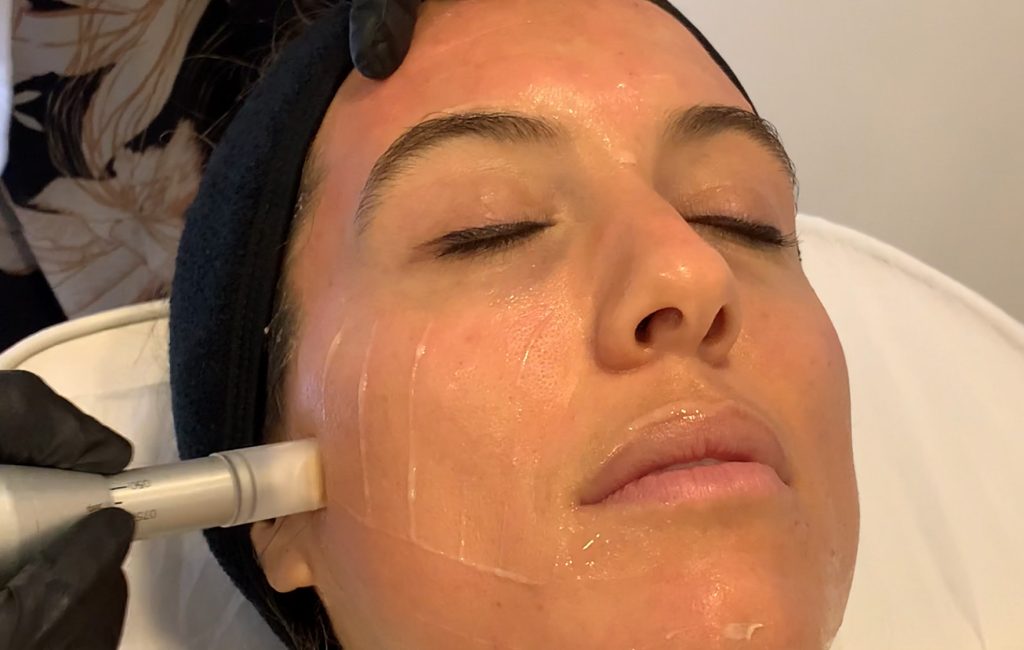 microneedling1